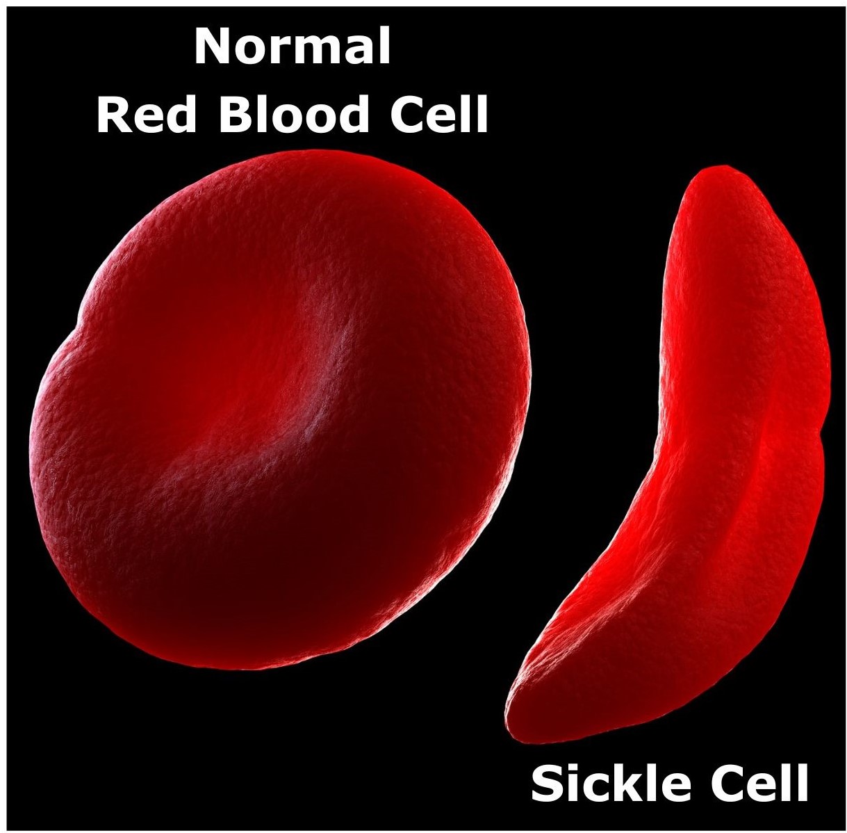 Normal red blood cell vs a sickle cell