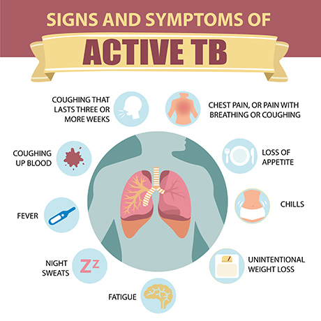 Signs and Symptoms of Active TB